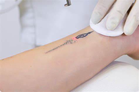 LASER TATTOO REMOVAL DEVICE + COURSE