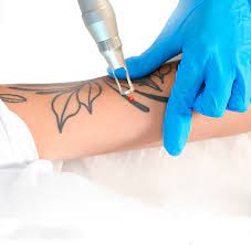 TATTOO REMOVAL COURSE IN PERSON